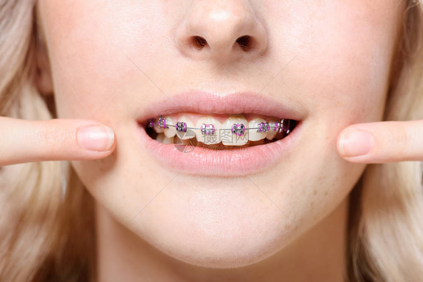 一名年轻女子用手指对着她的牙套紧图片