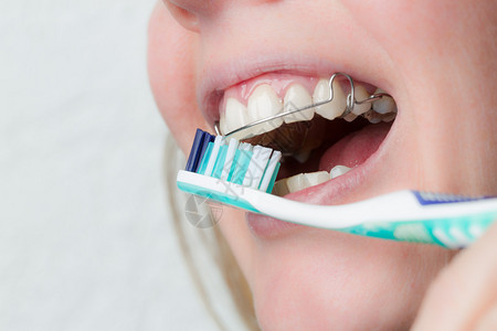 一张带牙套和牙刷的嘴图片