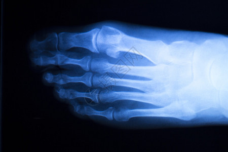 脚跟和脚趾受伤X射线扫描整形和创伤放射图片