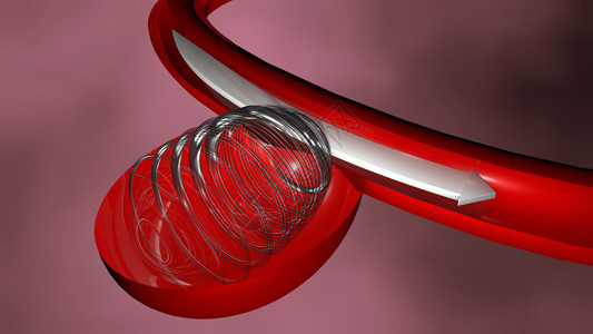 动脉瘤和血管内治疗螺旋背景图片