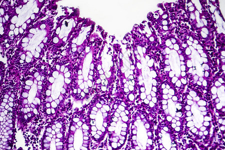 细菌痢疾光学显微照片显微镜下照片显示细菌的存在和炎图片