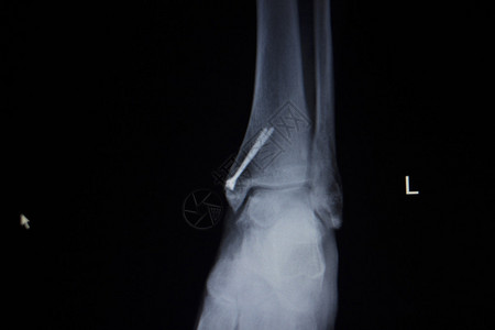 X射线整形医疗CT创伤医院诊所脚部疼痛伤的X光切片扫描并植图片