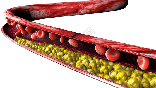 供应不正确胆固醇形成设计图片
