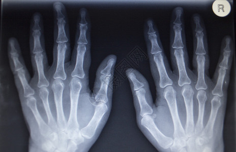 X射线整形医疗创伤医院诊所疼痛手拇指损伤的CAT扫描图片