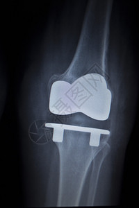 CAT扫描创伤医院诊所疼痛的膝部骨髓损伤腿部图片