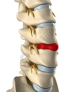 椎间盘与椎骨破裂图片