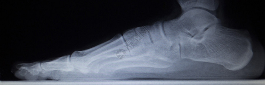 X射线整形医疗CAT创伤医院诊所疼痛足部伤痕扫描显示图片