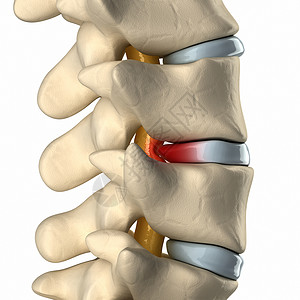 椎间盘突出压迫脊髓图片