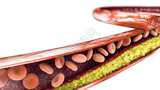 胆酯醇形成脂肪动脉静背景图片