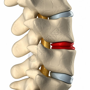 椎间盘退化图片