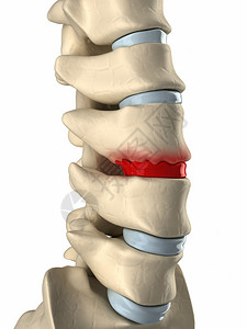椎间盘因骨赘形成而退化图片