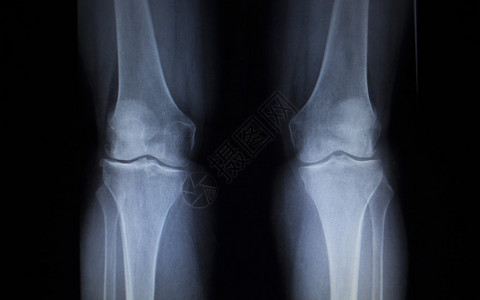 X射线整形医疗创伤医院诊所膝部骨髓受伤腿痛的图片