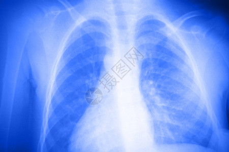 蓝色和白色的肺X射线照片背景图片