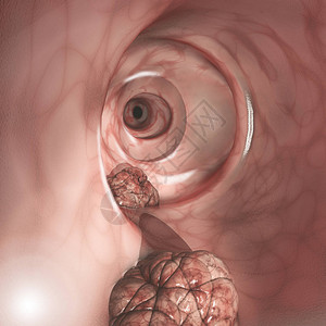 肠壁的内部视图结直肠癌CRC肠癌结肠癌或直肠癌侵入或扩散到身体其他部位的细胞异常生长背景图片