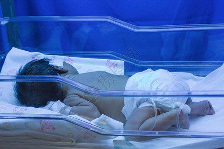 使用紫外灯治疗患糖尿病的新生婴儿在图片