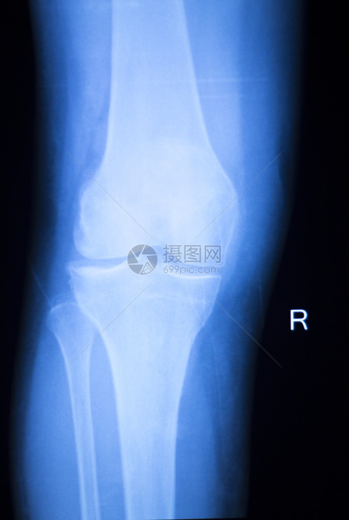 联合月经X射线扫描结果照片显示图片