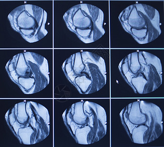 核扫描测试的结果是膝盖骨折伤照片血清图片