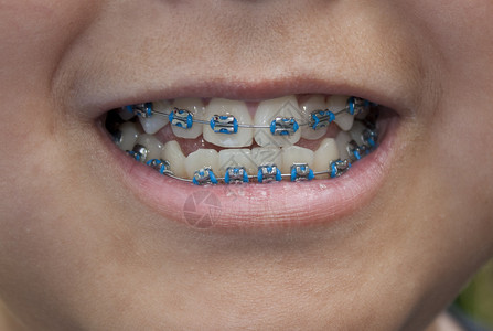 一个带蓝色牙套的小男孩的特写镜头图片