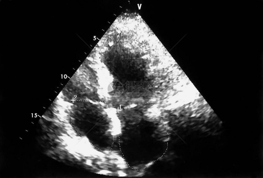 超声波图像回声心动机屏幕图片