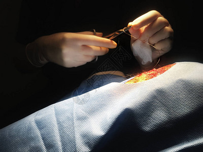 医生或护士的手在灯光下照亮缝上男人腿上图片