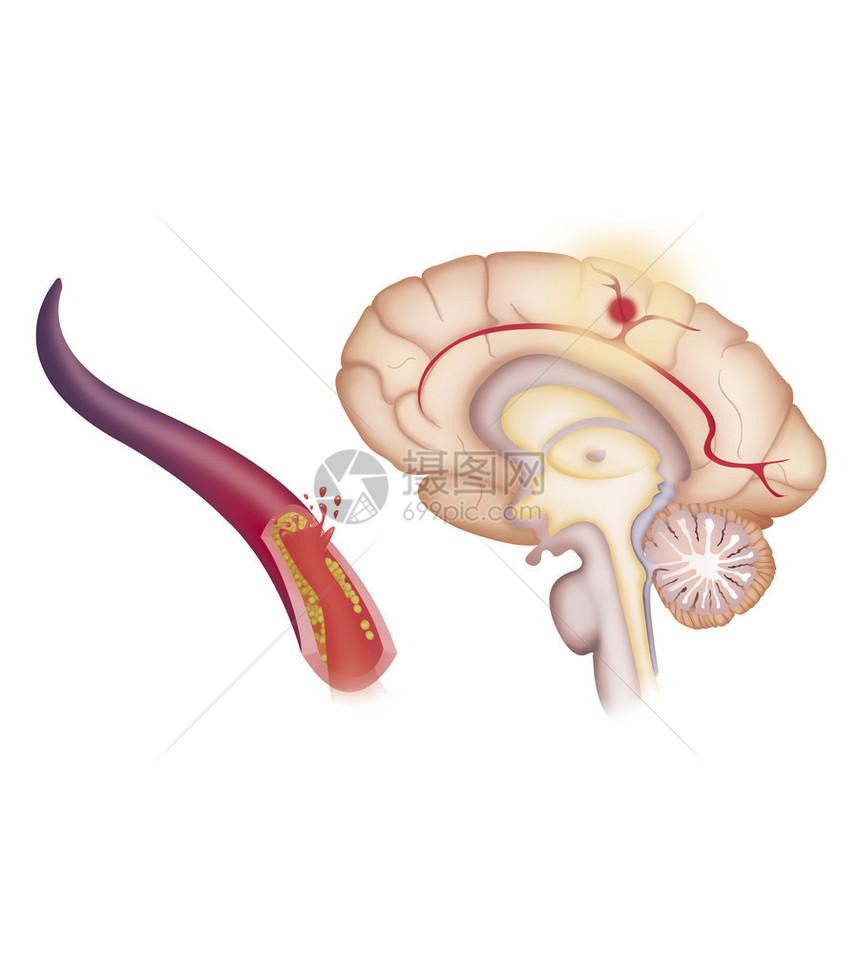 描述缺血中风或脑血管意外CVA图片