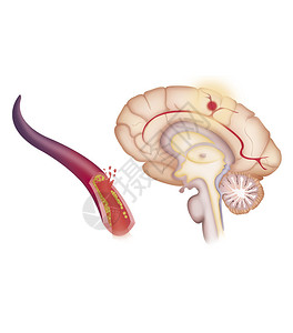 描述缺血中风或脑血管意外CVA背景图片