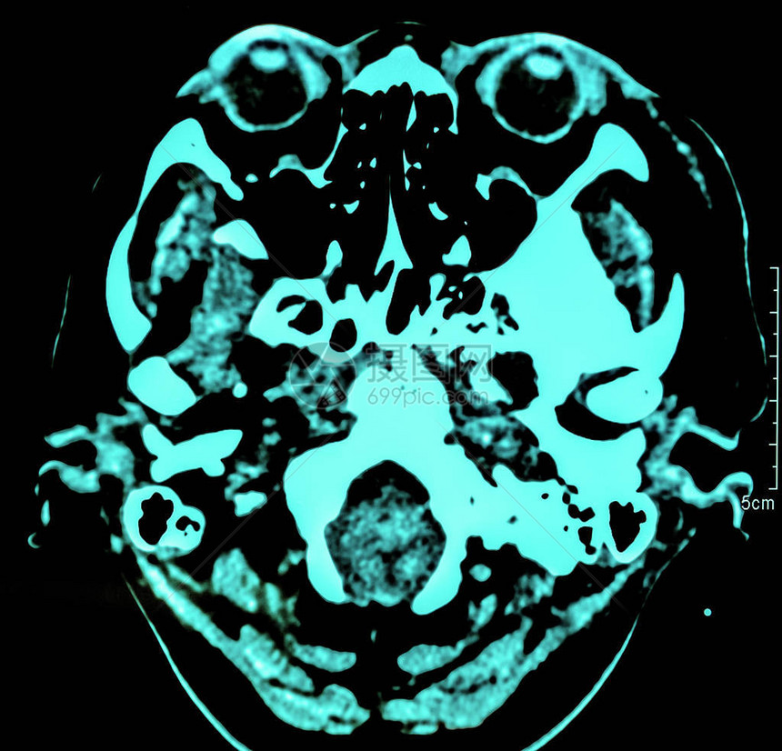 人体大脑计算机化胶片X射线透视CT扫图片