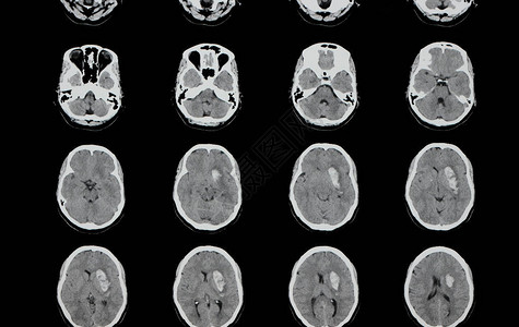 对左脑半球内大出血的病人进行脑计算机断层摄影CT扫描图片