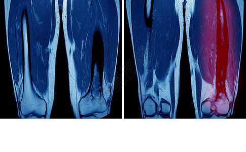 两种股骨的磁共振成像MRI图片