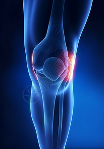 膝关节外侧副韧带损伤图片