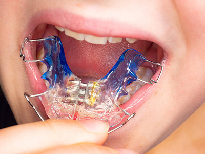 带正畸牙套的患者牙齿照片戴牙套是修复先天颌骨缺陷的非常流图片