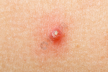 丘疹性荨麻疹脓疱囊痤疮的特写照片背景