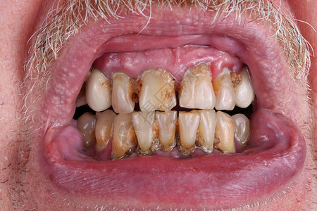 老人的牙齿被蜂蜜塔和贫乏的浪费组合所腐蚀酒精和烟草概念的危害工图片