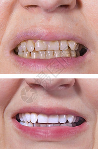 牙齿美白从黄色到白色之前和之后的情图片