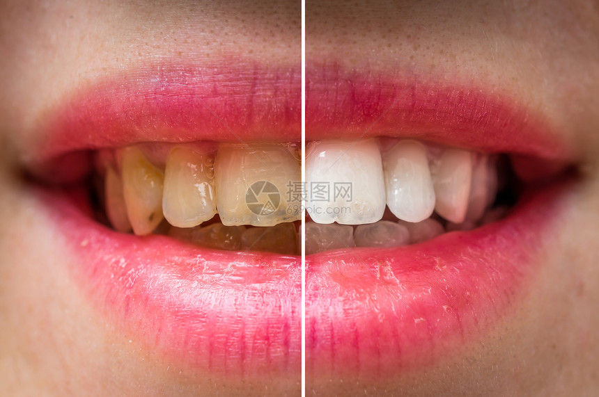 牙科治疗前后的女牙齿图片