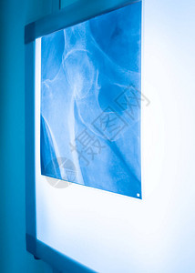 带有股骨折和骨盆质折X射线的图片