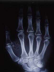 X光图像男人手背景图片