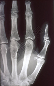 X光图像男人手图片