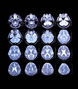 脑部计算机断层扫描中枢神经系统医学监测X射线MRICT图片