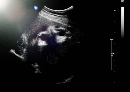 怀孕第三个月的胎儿超声怀孕第三个图片