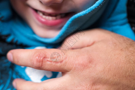 牙齿咬皮肤的痕迹儿童观图片