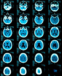 成年人的脑部X光片图片