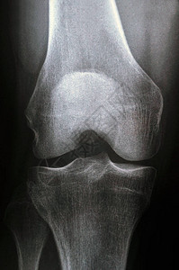 膝盖X光图片