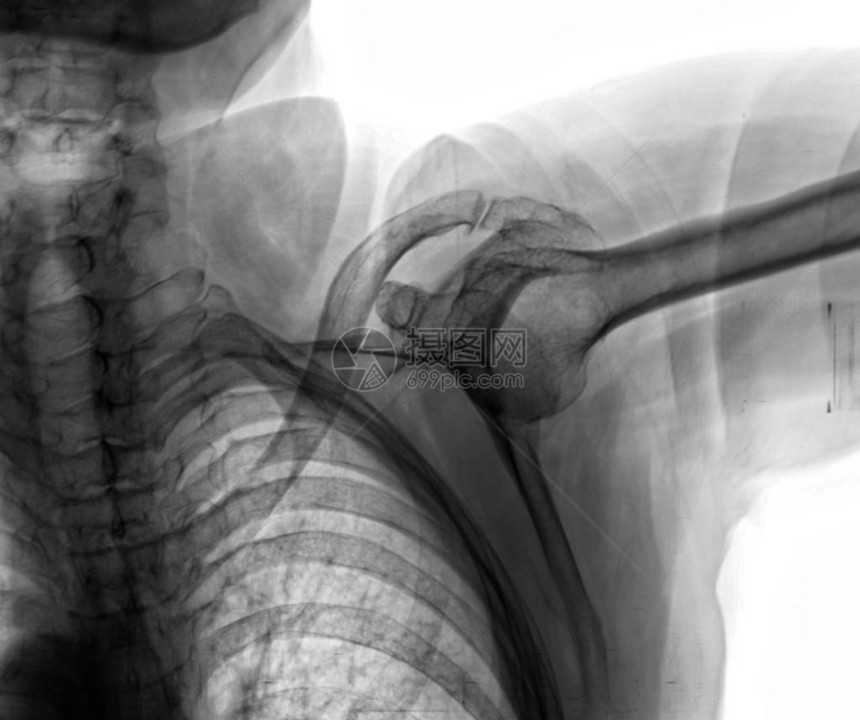 患者的诊断肩部X光片图片