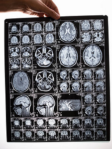 脑部核磁共振成像扫描图像图片
