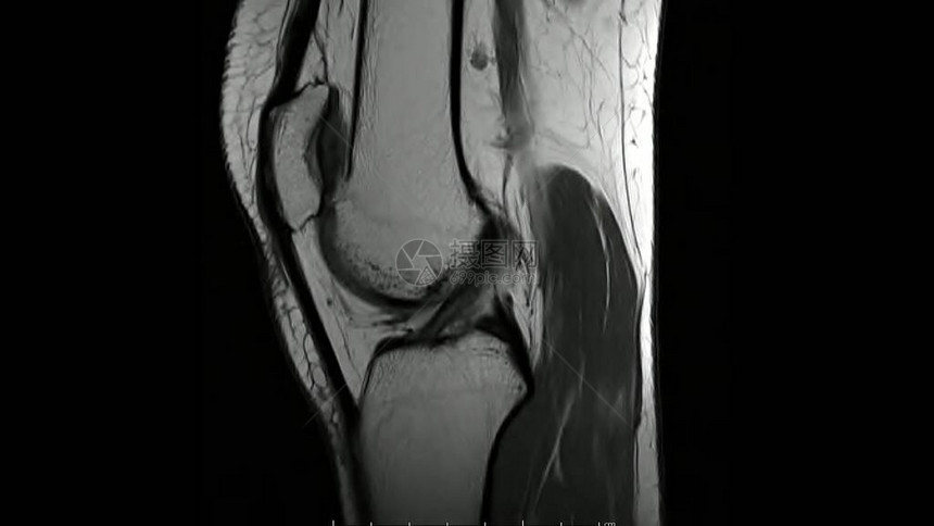 显示膝盖解剖图象的KneeGittatalT1加权图像iMRIKnee联合图片