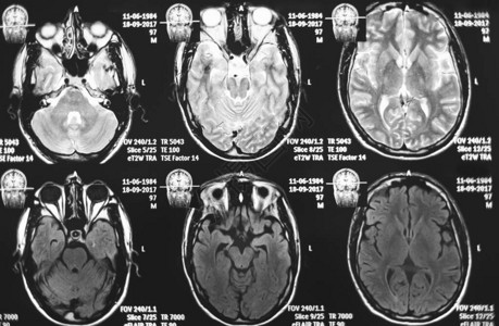 脑电磁共振扫描核磁共振头部扫描图片