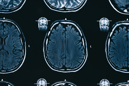 脑电磁共振扫描核磁共振头部扫描图片