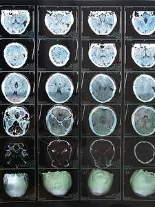 在创伤后脑部受伤后对人体大脑进行BaiMRI扫描的MRI图片