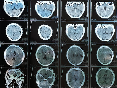 在创伤后脑部受伤后对人体大脑进行BaiMRI扫描的MRI图片